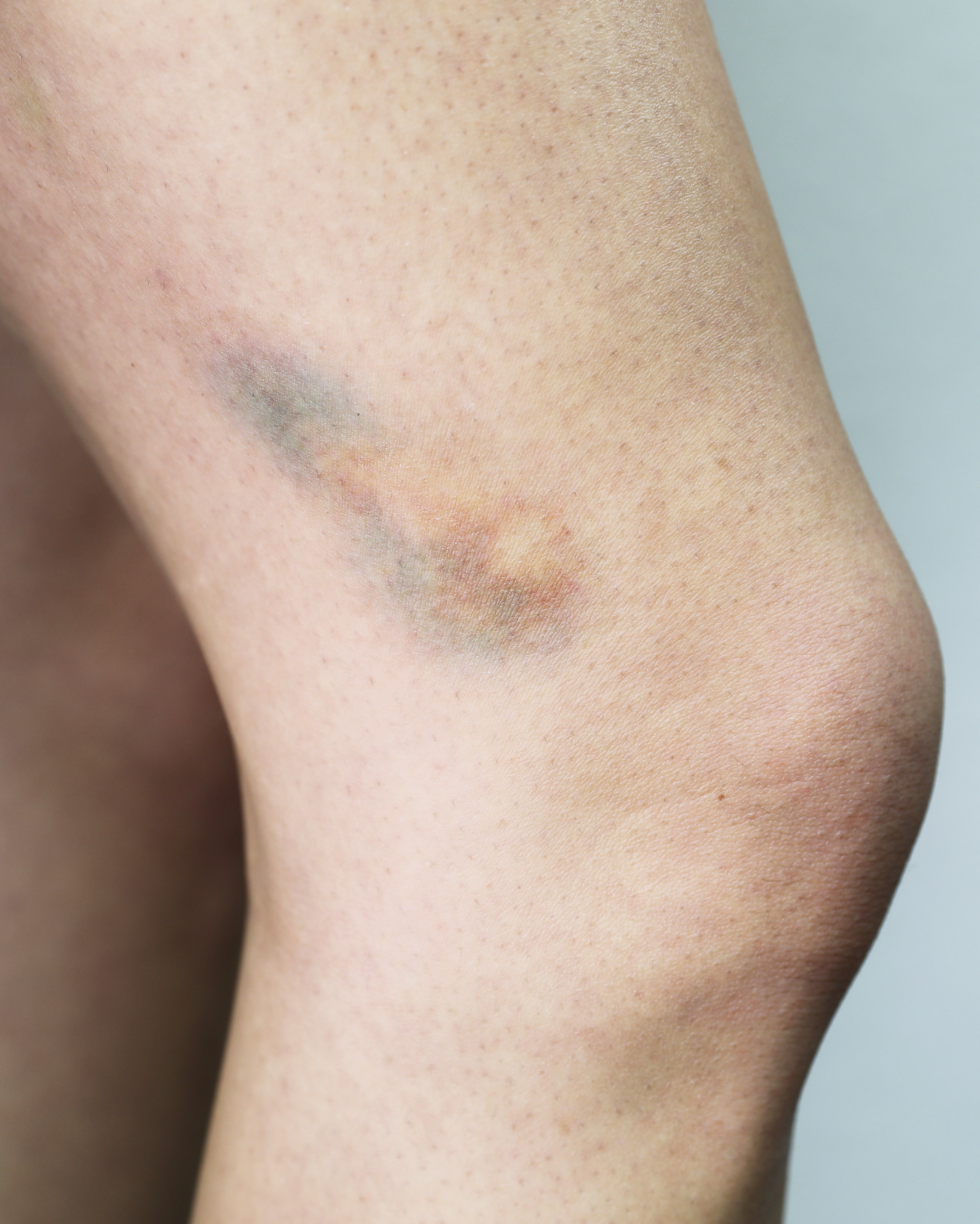 Bruises-2C-9