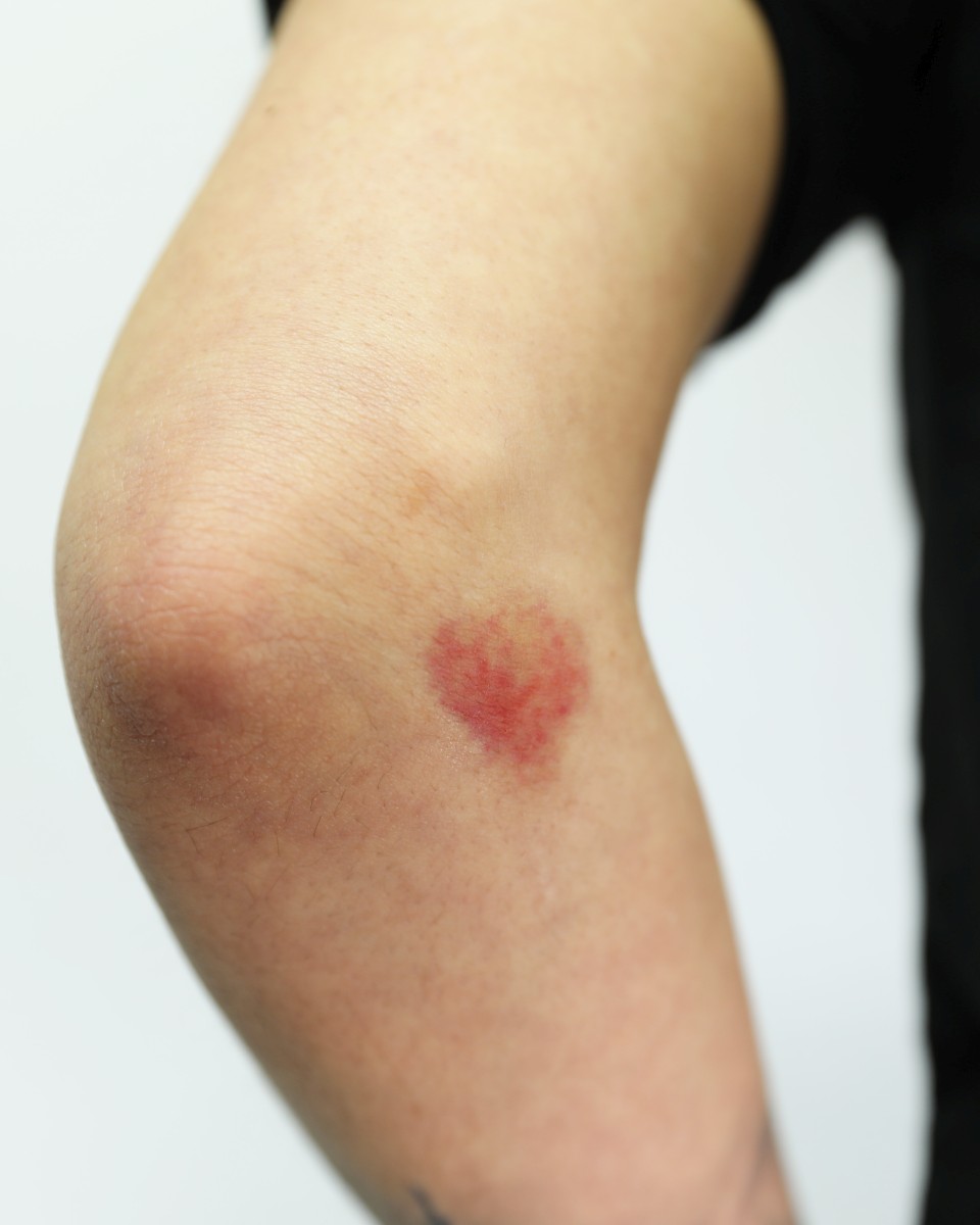 Bruises-2A-4_smaller Bruises 2A