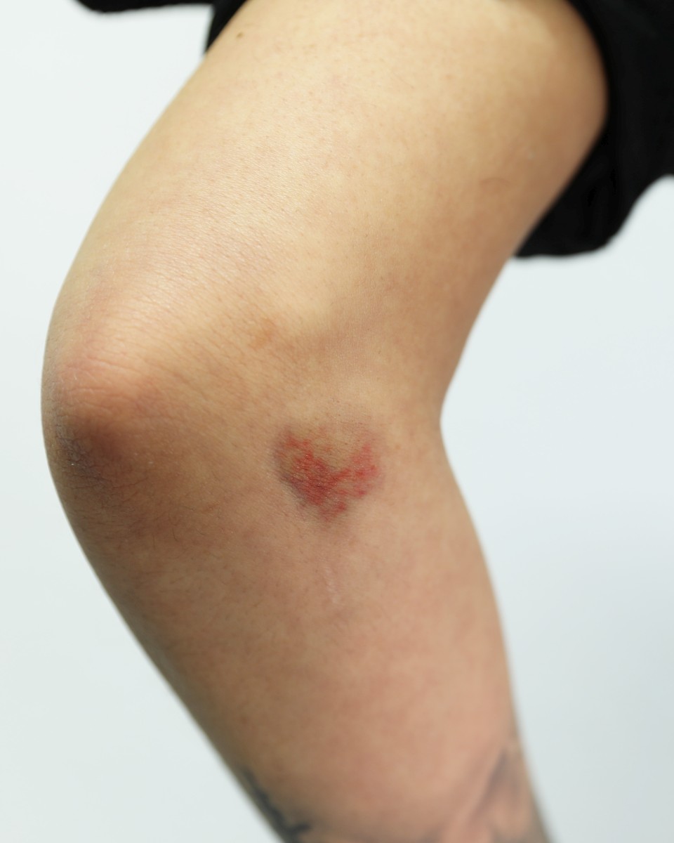 Bruises-2C-4_smaller Bruises 2C