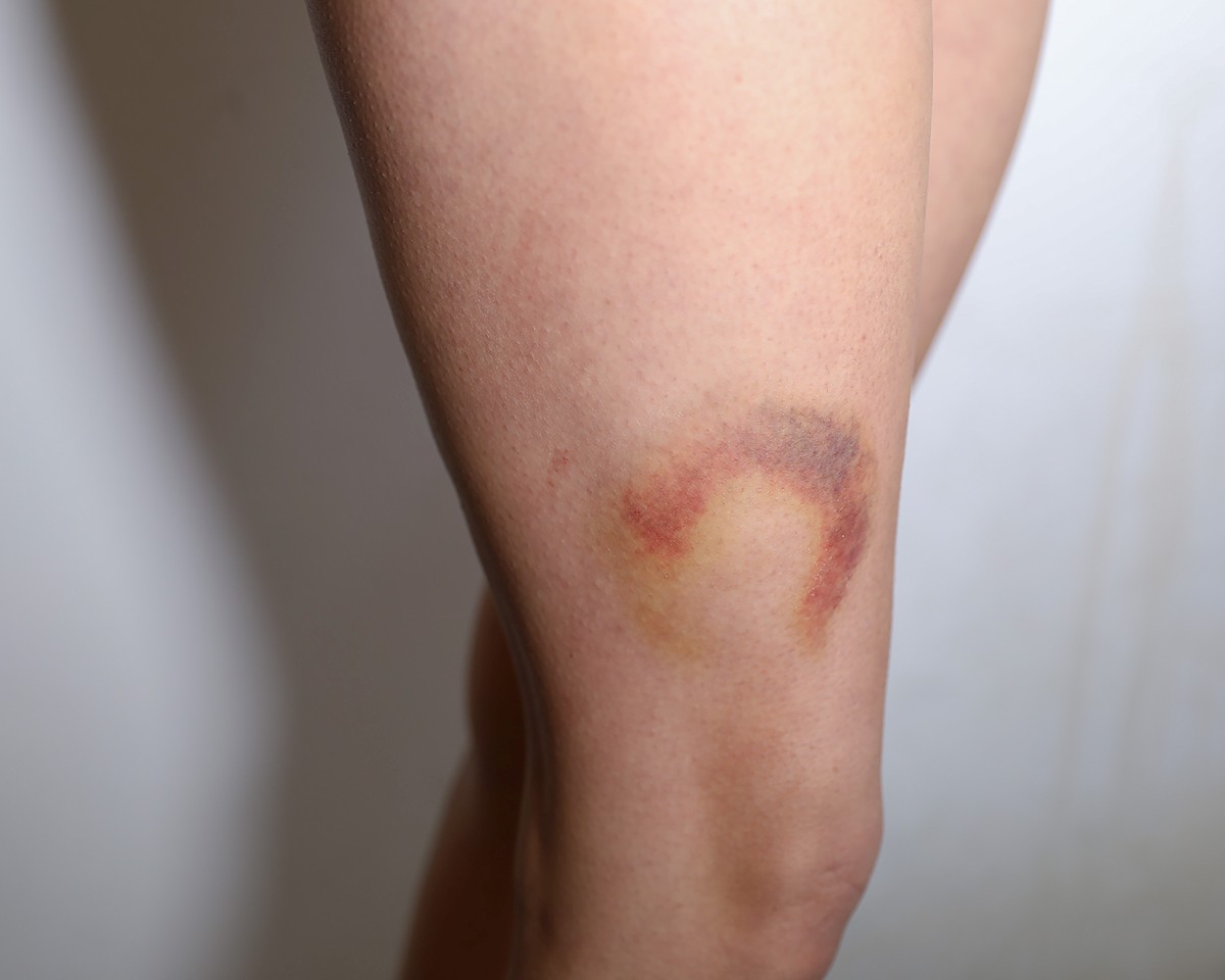 VIC_0746-edited_smaller Bruises 3C