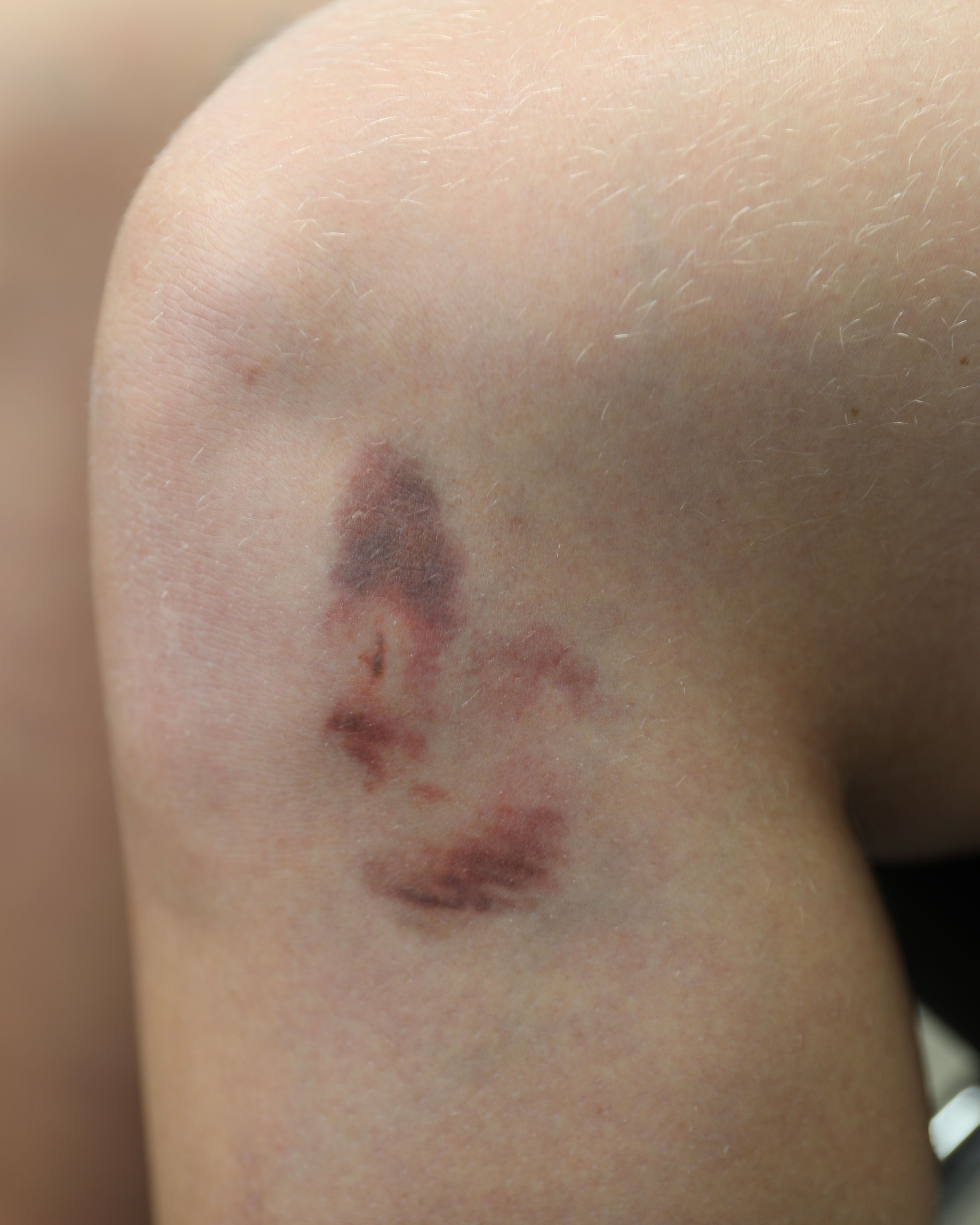 Bruises-1C5-croppedNJbg9OmAYxMWV