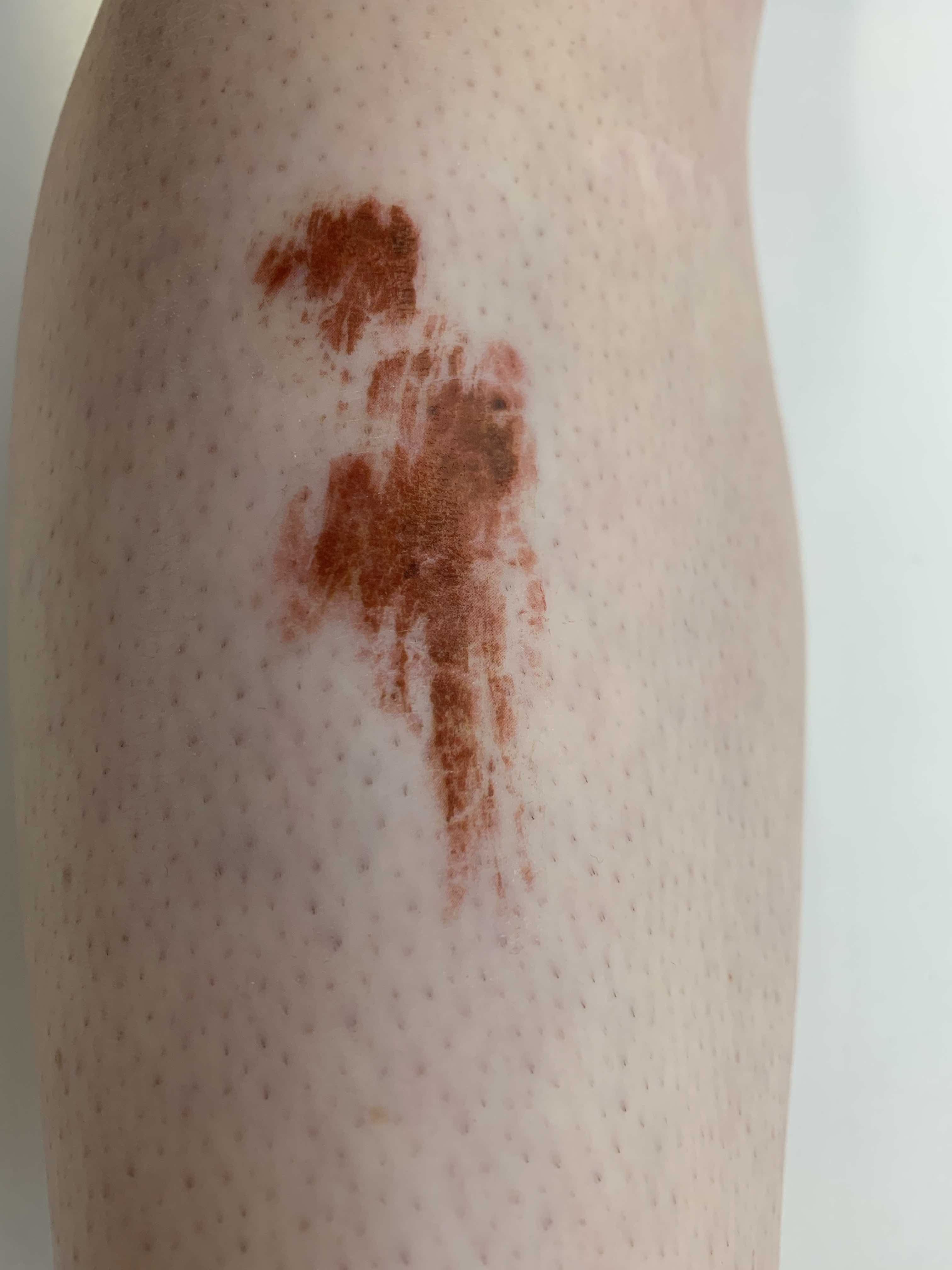 TC_Skinscrapes2-11_appliedLqunwERYMEKyL