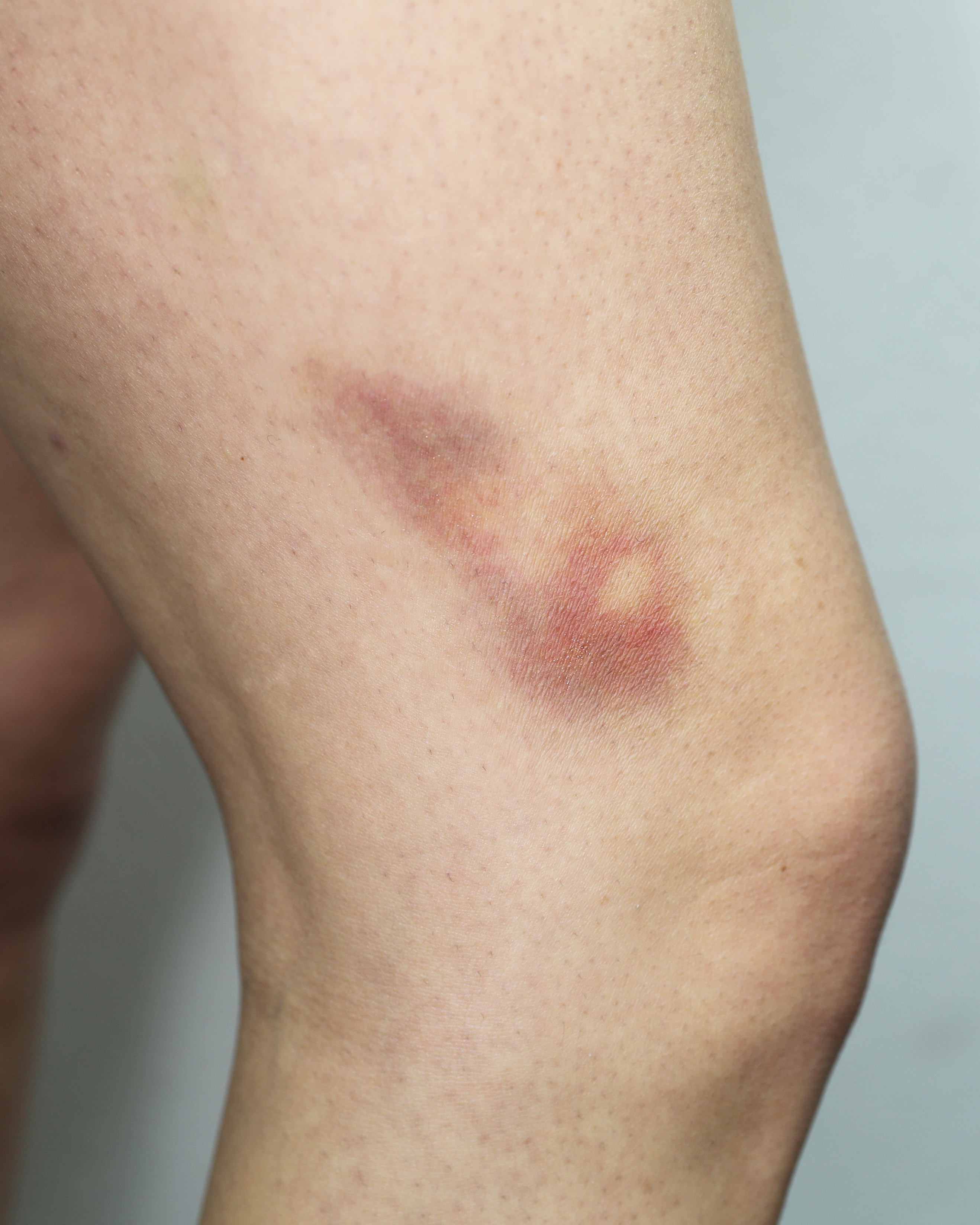 Bruises-2B-9
