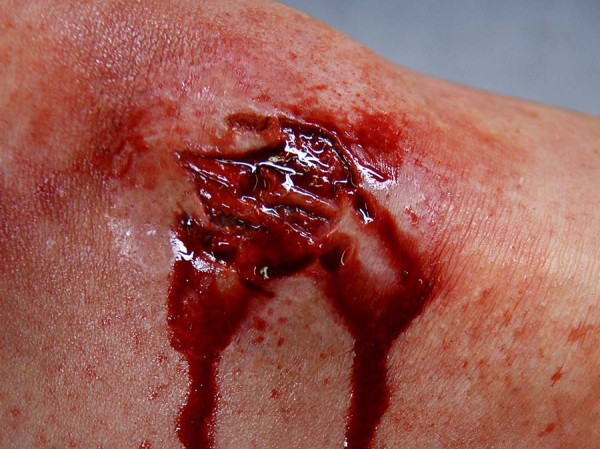 LW1 Laceration Wound