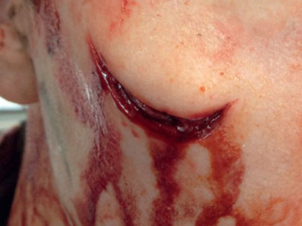 LW5 Laceration Wound