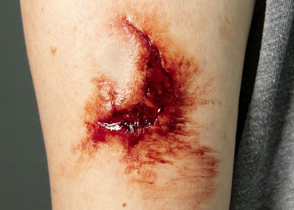 LW10 Laceration Wound