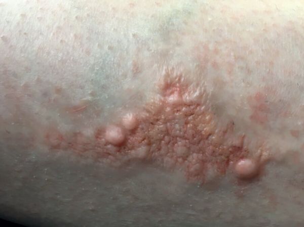 SD5 Skin Disease