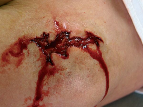LW3 Laceration Wound