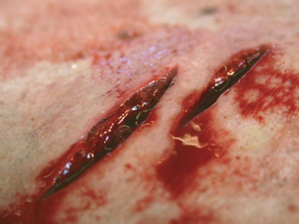 SW2 Stab Wound