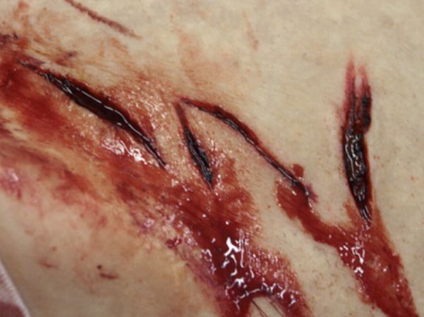 SW7 Stab Wound