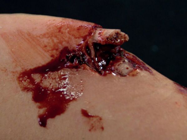 LW6 Laceration Wound