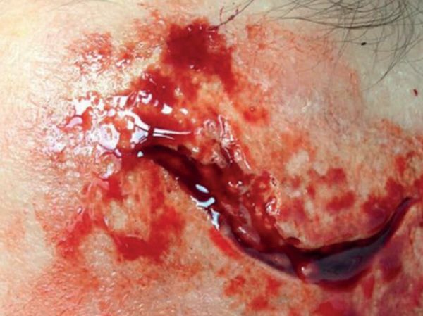 LW4 Laceration Wound