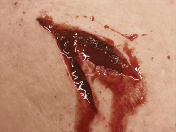 SW5 Stab Wound