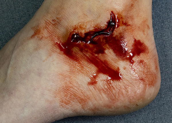 LW11 Laceration Wound