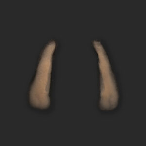OA5_Nasolabialfalten L+R