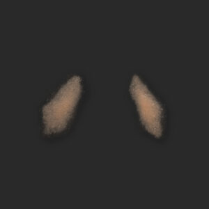 OA6_Nasolabialfalten L+R (subtil)