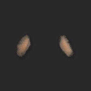 OA7_Nasolabialfalten L+R