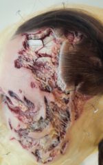 Gesichts-Prosthetic: Multitrauma 2 – Bild 3