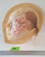 Gesichts-Prosthetic: Starke Vernarbung