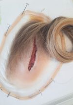 Kopfplatzwunde mit Haar – Bild 2