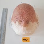 Vernarbte Halbglatze 1