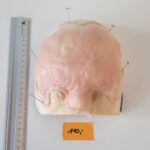 Vernarbte Halbglatze 2