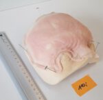 Vernarbte Halbglatze 2 – Bild 2