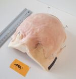 Vernarbte Halbglatze 2 – Bild 3