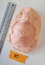 Vernarbte Nase + Lippe + Kinn_1 – Bild 2
