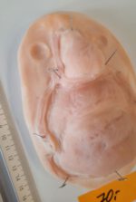 Vernarbte Nase + Lippe + Kinn_1 – Bild 3