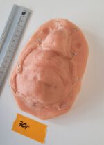 Vernarbte Nase + Lippe + Kinn_2 – Bild 3