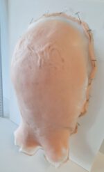 Vernarbter Hinter- und Oberkopf_1 – Bild 3