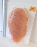Vernarbter Hinter- und Oberkopf_2 – Bild 2