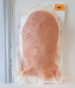 Vernarbter Hinter- und Oberkopf_3