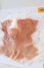 Vernarbtes Gesicht + Hals – Bild 3