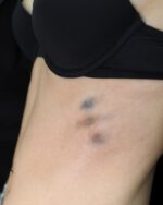 Bruises 2 Set