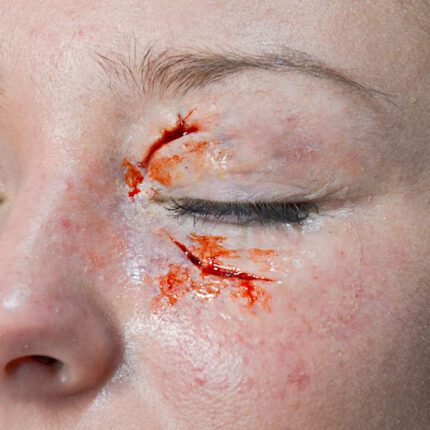 SB3 Geschwollenes Auge (links)