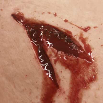 SW5 Stichwunde