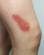 Bruises 2A