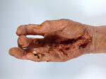 Walda - Infizierte rechte Hand BACKGROUND