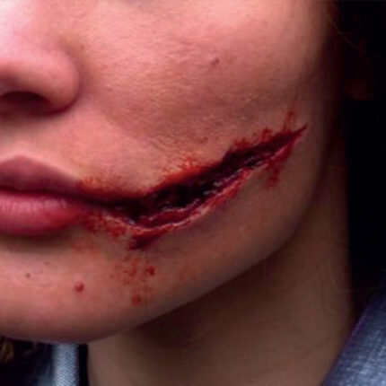 L9 Risswunde (links)