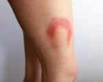Bruises A - Fresh Bruises Set