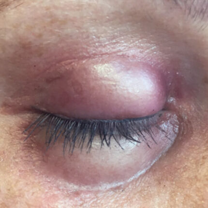 SB5 Geschwollenes Auge (rechts)