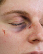 Black Eye A