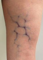 Big Vessels Veins 03