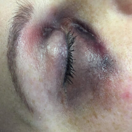 SB7 Geschwollenes Auge (rechts)
