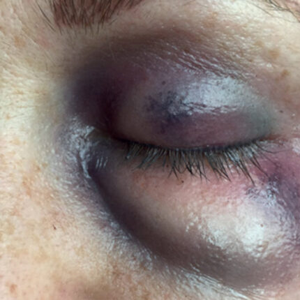 SB6 Geschwollenes Auge (links)