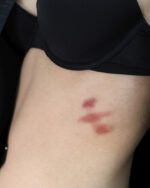 Bruises 2 Set