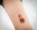 Burn Wounds