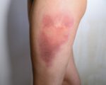 Bruises 3 Set